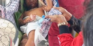 Amora Purba Terbakar, Kondisi Sangat Memprihatinkan, Butuh Uluran Tangan