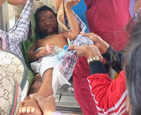 Amora Purba Terbakar, Kondisi Sangat Memprihatinkan, Butuh Uluran Tangan